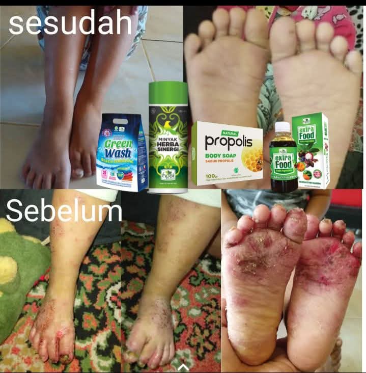 Alhamdulillah Tito mau berbagi testimoni herbal yang luar bHNIiasa Masyaallah,